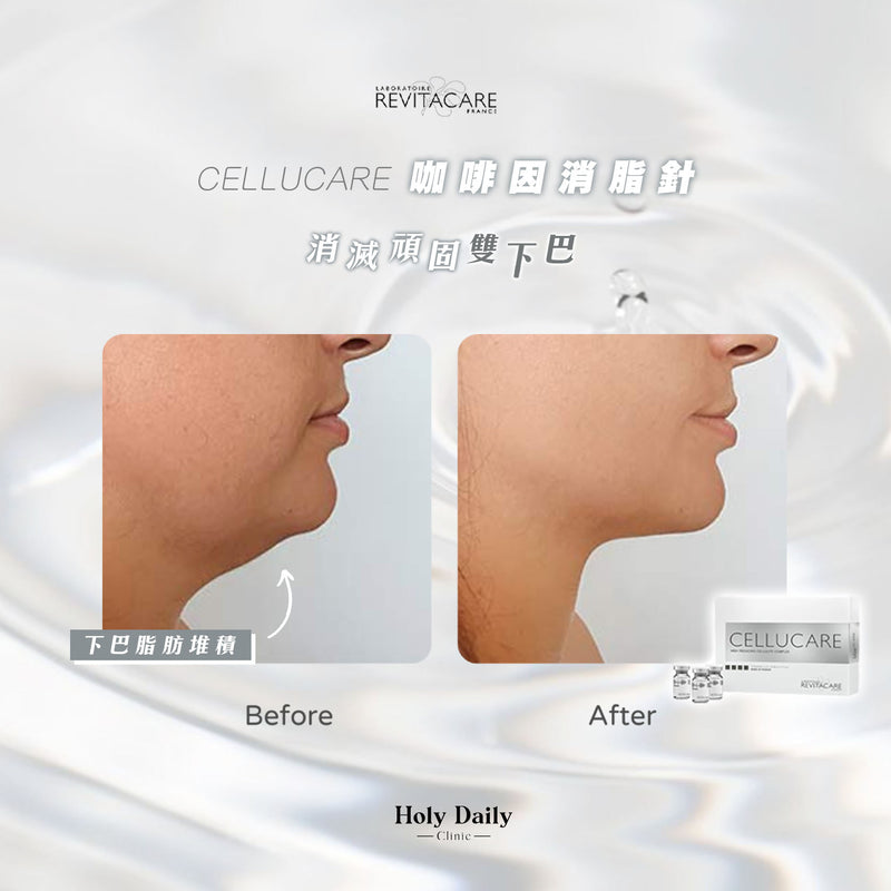 【醫生主理】CELLUCARE® 咖啡因消脂針