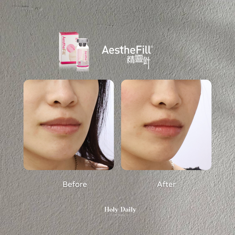 AESTHEFILL® 精靈針