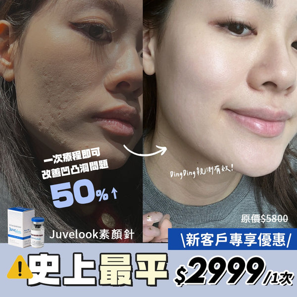 【醫生主理】Juvelook 凹凸洞素顏針(非填充類) \新客優惠價$2999/