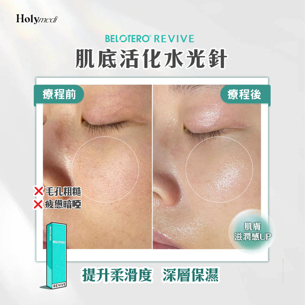 【醫生主理】BELOTERO® REVIVE 肌底活化水光針