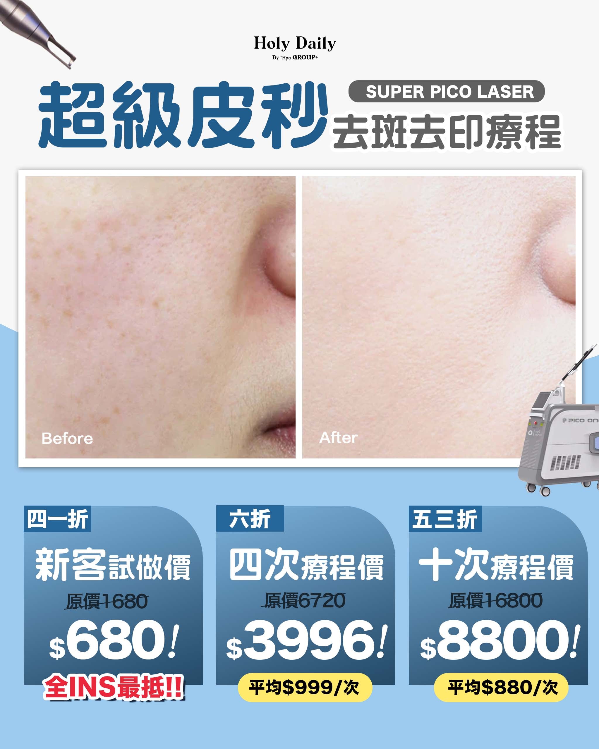\ 煥膚計劃 / SUPER PICO LASER 超級皮秒去斑去印療程 – Holy Daily