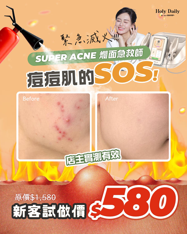 \ 新客限定 /SUPER ACNE 爛面急救師